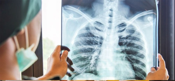 tuberculosis