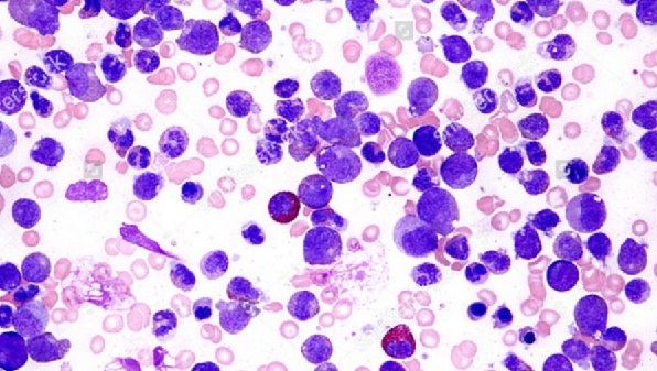leucemia