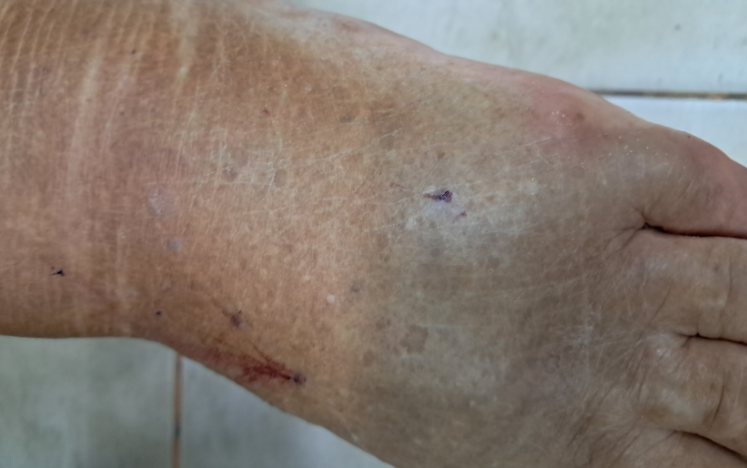 Goya: una mujer pisó accidentalmente una yarará en su patio y terminó internada