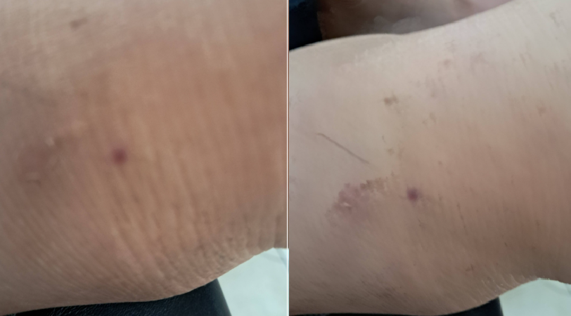 GOYA: EMPLEADO MUNICIPAL FUE HERIDO POR UNA PICADURA DE YARARÁ